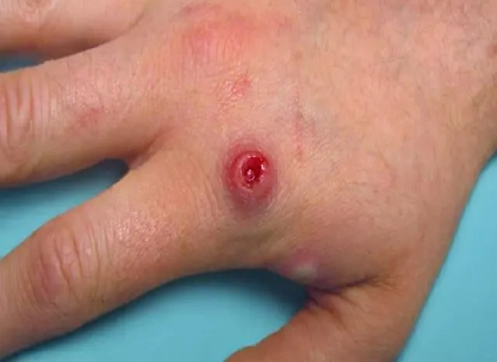 Monkeypox a thuiscint agus conas é a chosc？