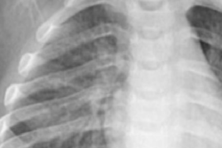 Brath tapa ar chlamydia pneumoniae: iontaofa agus éifeachtach